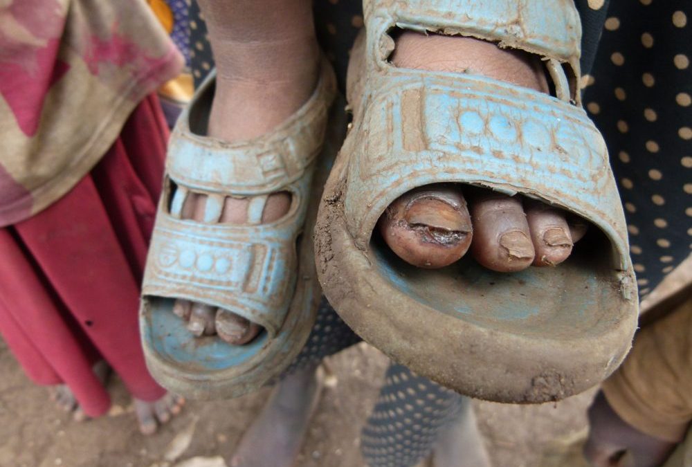 Beginn eines Riesenprojektes: Kampf gegen Jiggers